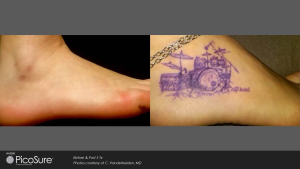 Tattooentfernung Vorher Nachher Schaffhausen — Ergebnis 1