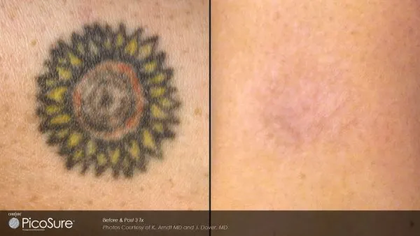 Tattooentfernung Vorher Nachher Schaffhausen — Ergebnis 2