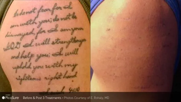 Tattooentfernung Vorher Nachher 3 Schaffhausen