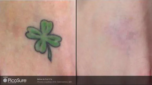 Tattooentfernung Vorher Nachher 5 Schaffhausen