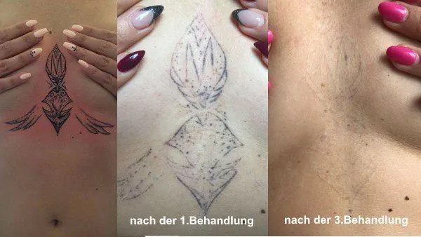 Tattooentfernung Ergebnis nach 6 Behandlungen Schaffhausen